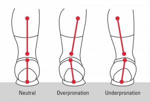 overpronation