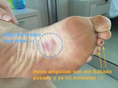 Hematoma pie izquierdo.jpg
