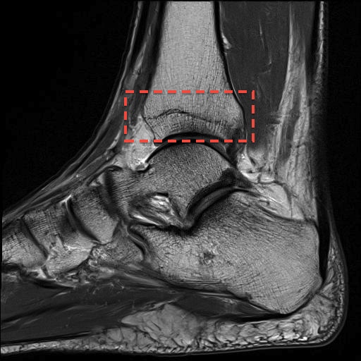 tibial_distal.jpg