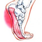 plantar_fasciitis