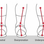 overpronation